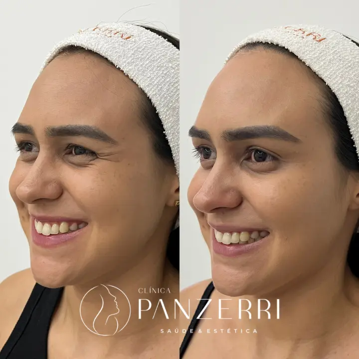 AnyConv.com__BOTOX-1