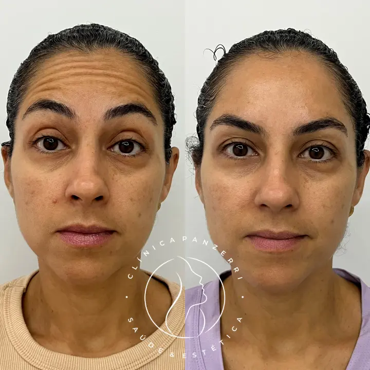 AnyConv.com__BOTOX-2