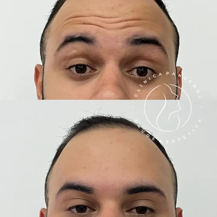 AnyConv.com__BOTOX-3